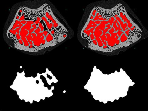 Bone Morphometry In Micro Ct Separating Trabecular And Cortical Bone