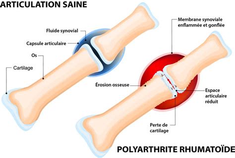 La Polyarthrite Rhumatoïde Causes Symptômes Et Traitements