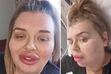 How Many Days Do Lips Swell After Fillers Lipstutorial Org