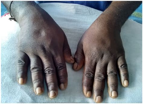 Bilateral Symmetrical Pitting Edema Of The Dorsum Of The Hands