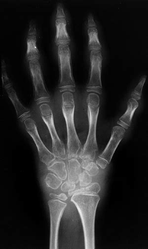 Juvenile Idiopathic Arthritis Teachme Orthopedics