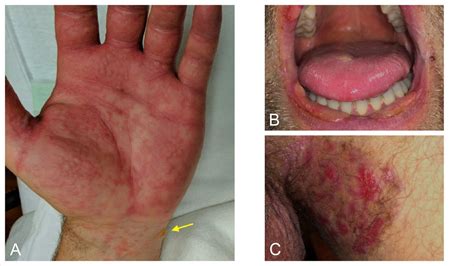 Idiopathic Linear Iga Bullous Dermatosis Treated With Prednisone Bmj