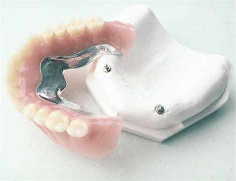 Removable Prosthodonticsdentures At Semdent Digital Laboratory Semdent