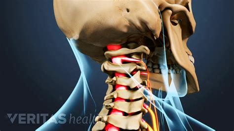 Cervical Radiculopathy From A Herniated Cervical Disc Spine Health