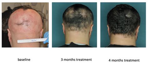 Drug Restores Hair Growth In Patients With Alopecia Areata Columbia