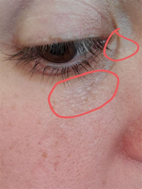 Under Eye Bumps Not Milia Undereye Skin Dry Skin Under Eyes Bumps
