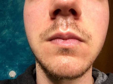 Skin Concerns Redness And Dry Skin Around Mouth Chapped Lips