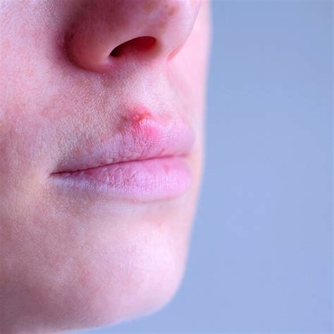 What Is The Difference Between Cold Sores And Mouth Ulcers News