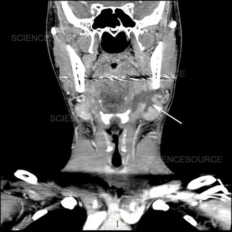 Photograph Submandibular Gland Abscess Ct Scan Science Source Images