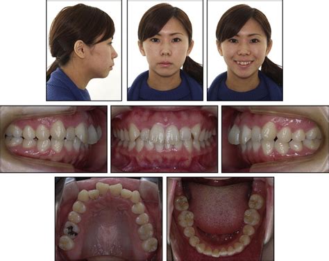 Esthetic Orthodontic Treatment With A Double J Retractor And Temporary