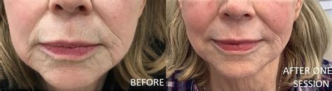 Genius Rf Microneedling Before And After Photos Patient 19 Washington Dc Mi Skin Dermatology