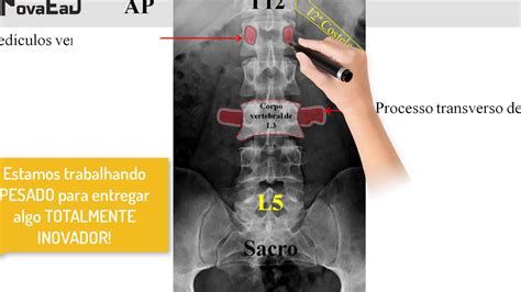 Anatomia Radiol Gica Da Coluna Lombar Imaginologia Novaead Em Breve Youtube