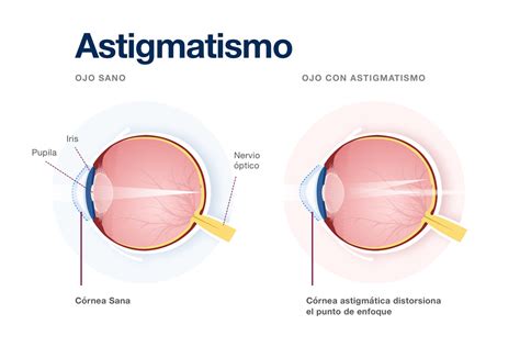 Apec Astigmatismo