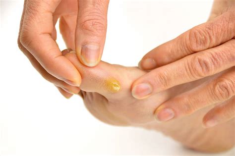 Can I Remove Minor Calluses From My Feet Jaws Podiatry