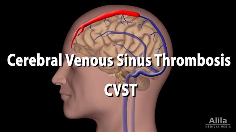 Cerebral Venous Sinus Thrombosis Cvst Animation Youtube