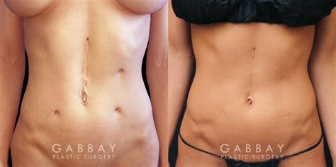 Scar Revision Before And After Photo Gallery Gabbay Plastic Surgery