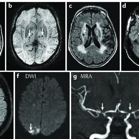 Age Related White Matter Lesions And Cerebrovascular Disease Lesions