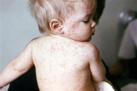 Disney Measles Outbreak Grows To 79 Cases In 7 States Mexico