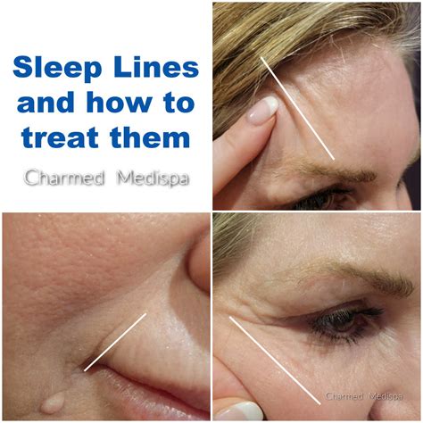 The Distinction Between Sleep Lines And Aging Lines Charmed Medispa