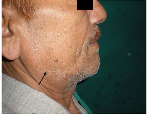 Profile View Showing Diffuse Submandibular Swelling Download