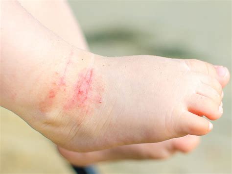 La Dermatite Atopica Nei Bambini Cause Sintomi E Le Cure Da Fare