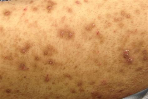Derm Dx Pruritic Papules In A Healthy 42 Year Old Woman Clinical Advisor