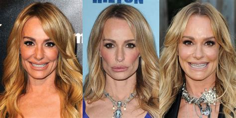 Taylor Armstrong Plastic Surgery Before And After Pictures 2018