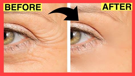 Eye Massage For Wrinkles Wrinkles Removal At Home Youtube