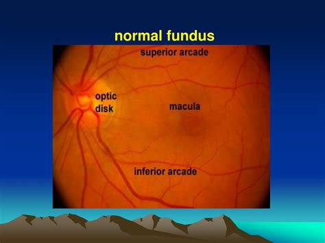 Ppt Normal Fundus Powerpoint Presentation Free Download Id5703760
