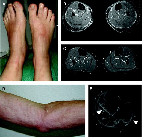 Can Mri Substitute For Biopsy In Eosinophilic Fasciitis Annals Of