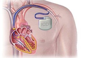 If your icd has a pacemaker feature when your heartbeat is too slow, it works as a pacemaker and sends tiny electric signals to your heart. Pacemaker - Know your Heart Blog