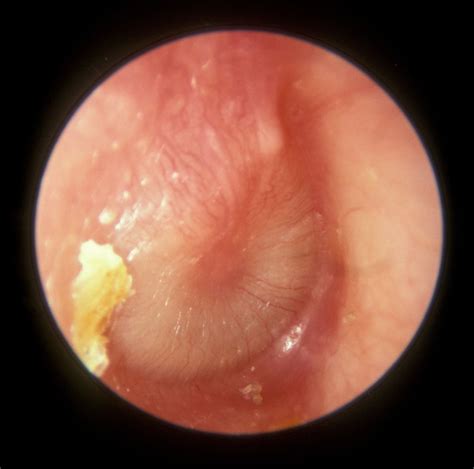 Doctor Forced To Chisel Out ‘worst Ever Case Of Earwax From Patient