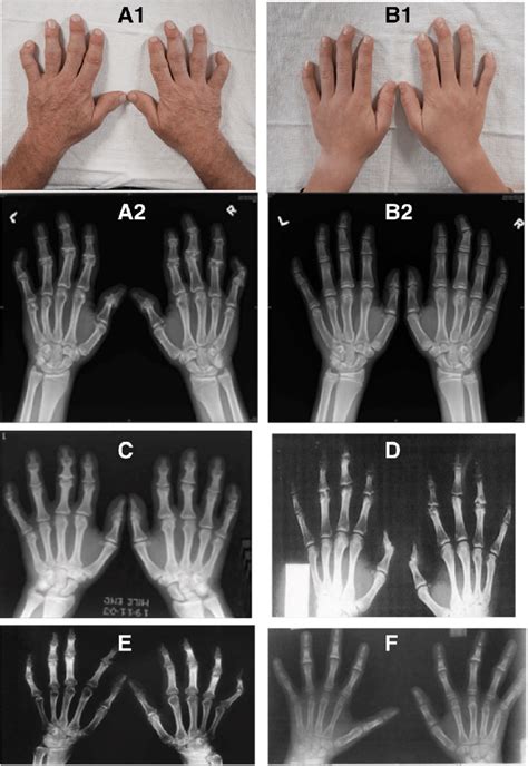 A1 A2 Patient Ii Multiple Bony Abnormalities Present