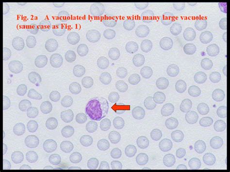 Lymphocyte Vacuolations And Inclusions