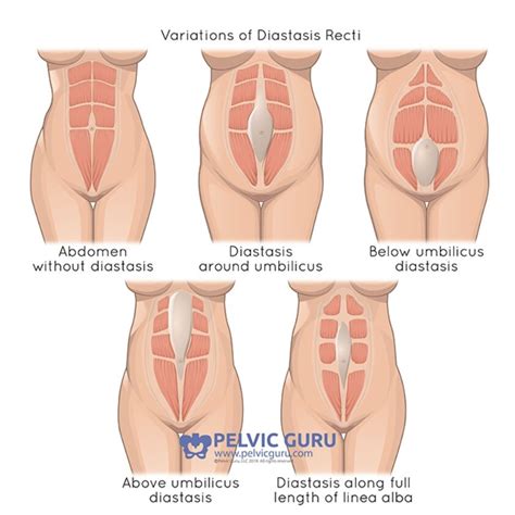What Does Diastasis Recti Look Like Visual Guide To Hernias The Best