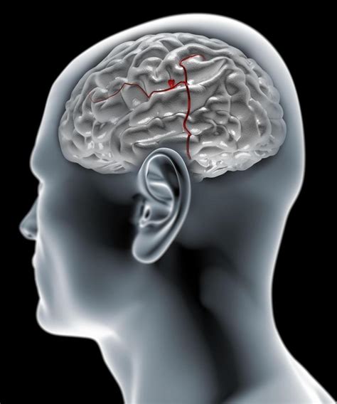 What Is A Brain Aneurysm Symptoms Signs And Causes All You Need To