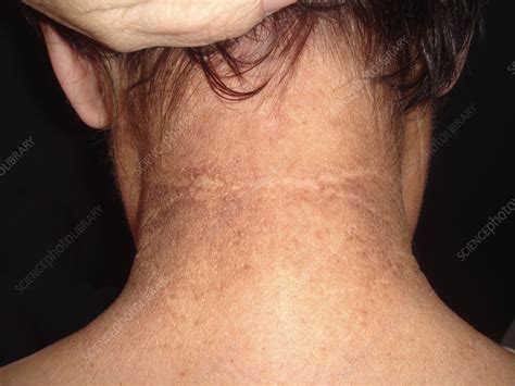Acanthosis Nigricans Stock Image C0459552 Science Photo Library