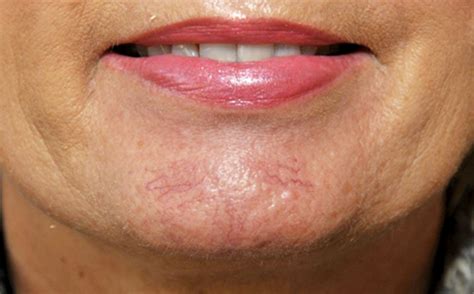 Facial Veins Diagnosis And Treatment Options The Pmfa Journal