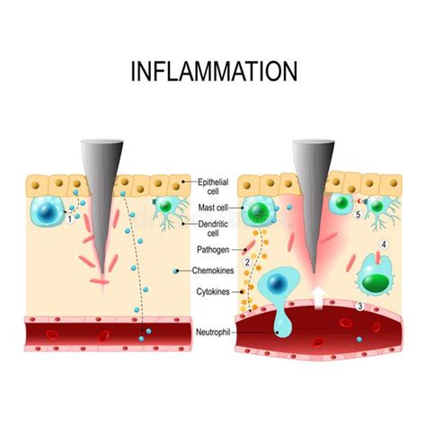 Inflammation Stock Illustrations 51110 Inflammation Stock