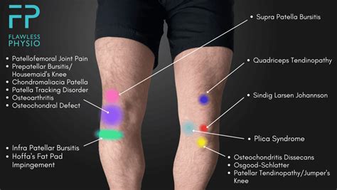 Knee Pain Location Chart Find The Cause Of Your Knee Pain