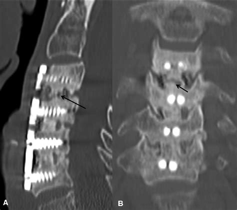 The Patient Underwent 3 Levels Of Anterior Cervical Fusion Surgery With