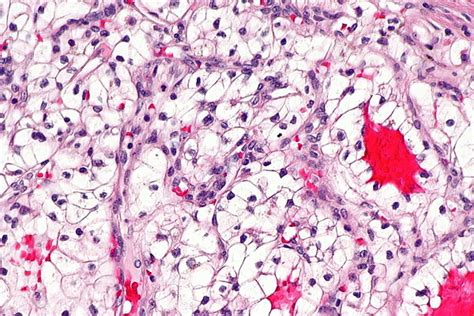 Clear Cell Renal Cell Carcinoma Libre Pathology