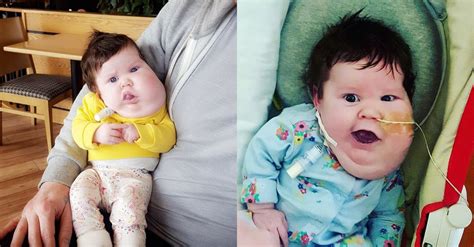 Miraculous Survival Baby Girl Overcomes ѕeⱱeгe Airway Obstruction At