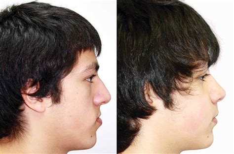 Face Nose Bite And Chin Asymmetry Correction Corrective Jaw