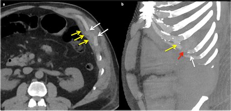 Cough Induced Costal Cartilage Fracture Clinical Imaging