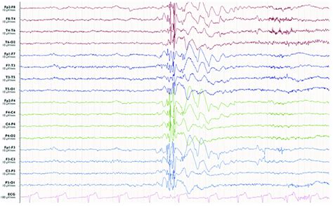 Electroencephalography Of A Myoclonic Seizure A Burst Of Generalized