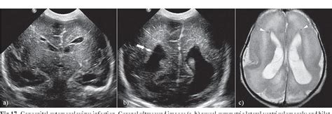 Abnormal Neonatal Head Ultrasound