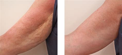Cellulite Treatments At Dermatology And Laser Of Del Mar