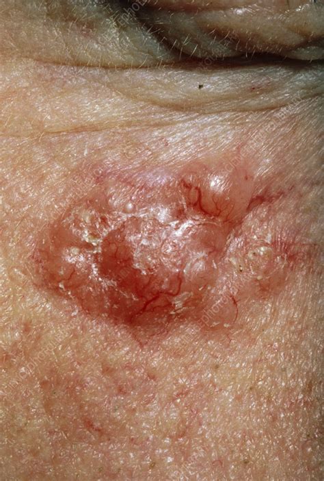 Basal Cell Carcinoma On A Patients Cheek Stock Image M1310253