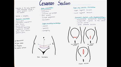 Cesarean Section Types Indications Incisions Etc Youtube